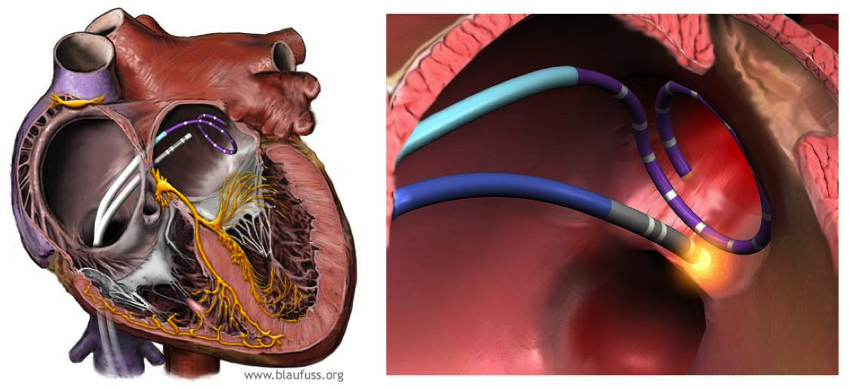 ARF Fibrillation auriculaire ARF Fibrillation auriculaire